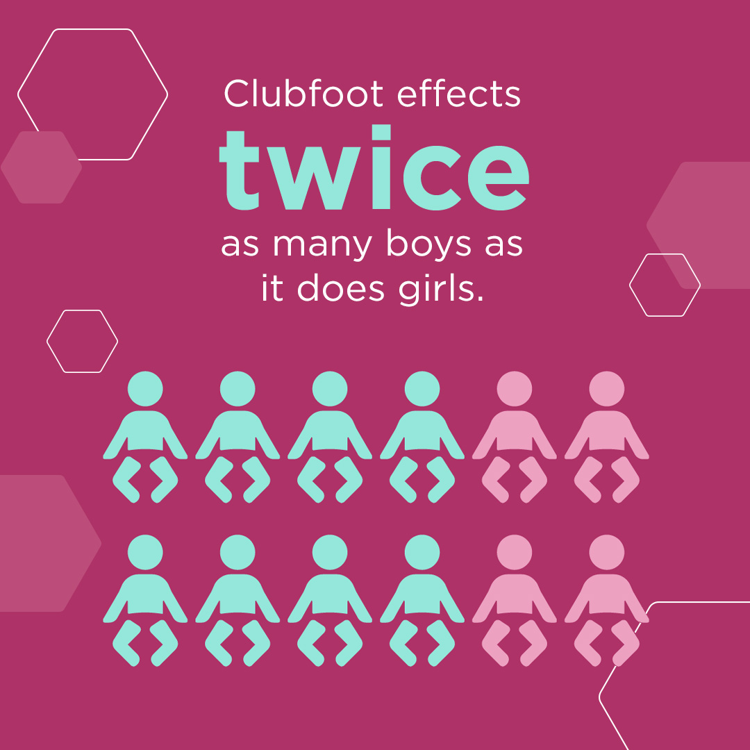 Clubfoot: Understanding & Treating a Common Childhood Condition