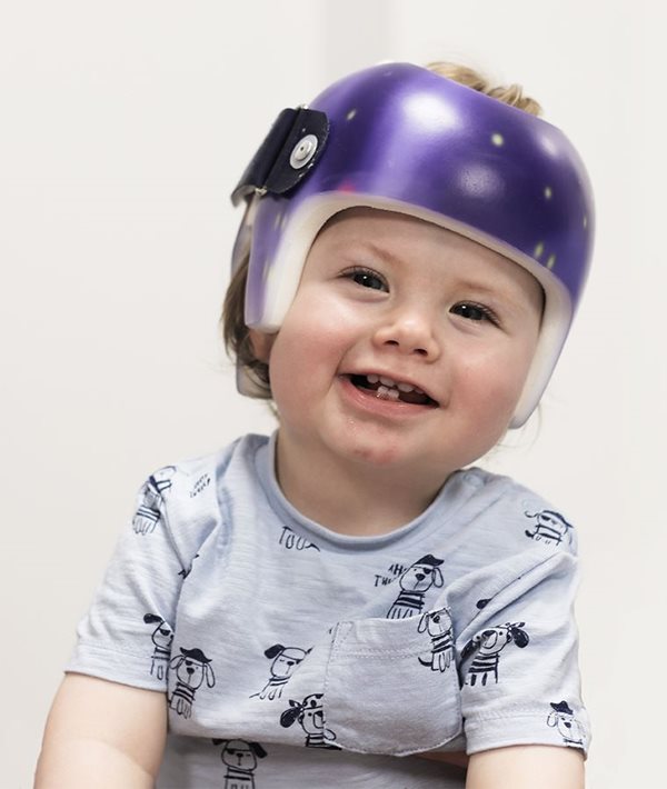 Does your baby need helmet therapy? 5 facts about flat head